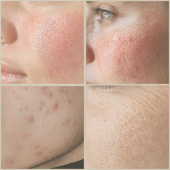 E-Book Online | Balans in huidproblemen